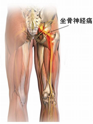 坐骨神経痛でお悩みの方は志摩腰痛館へ是非一度お越しください！